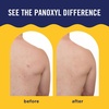 image:imagePanOxyl Acne Banishing Body Spray 2 Salicylic Acid For Body 6 oz6 Ounce Pack of 1