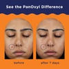 image:imagePanOxyl Acne Clearing Spot Treatment 10 Benzoyl Peroxide For Face 1 oz  Maximum Strength FastActing Clears amp Helps Prevent Acne Calms Redness With Allantoin Bisabolol amp Sodium Hyaluronate