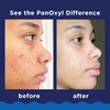 image:imagePanOxyl Acne Foaming Wash 10 Benzoyl Peroxide 3 oz Pack of 255 Ounce Pack of 1